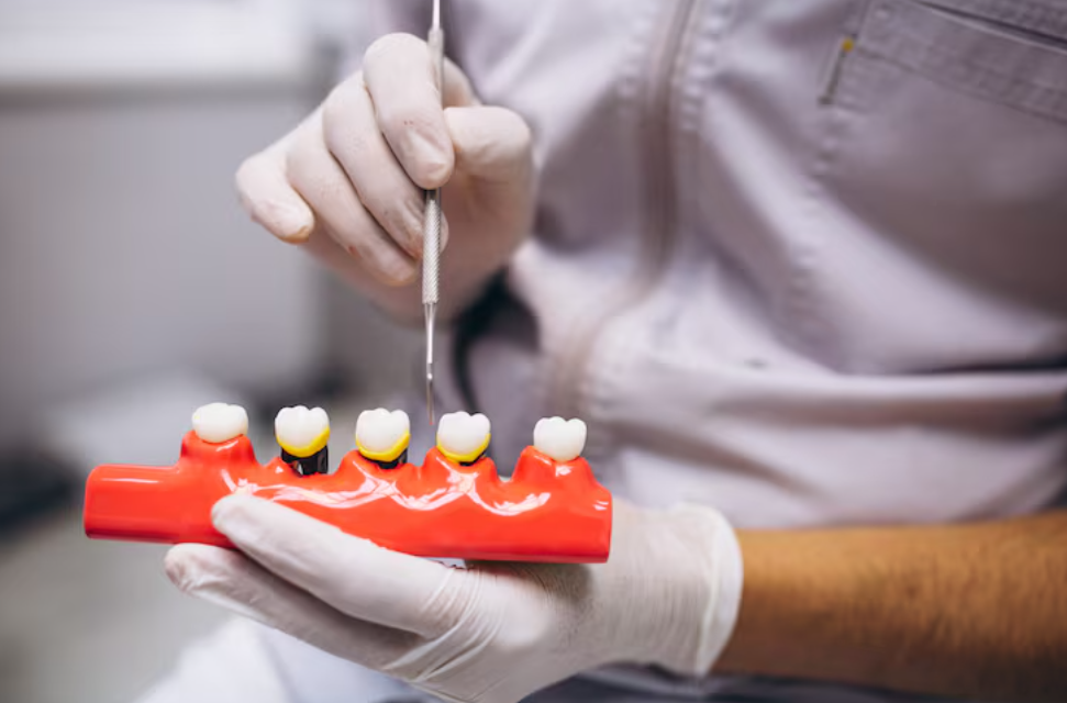 Crowns, Bridges and Veneers